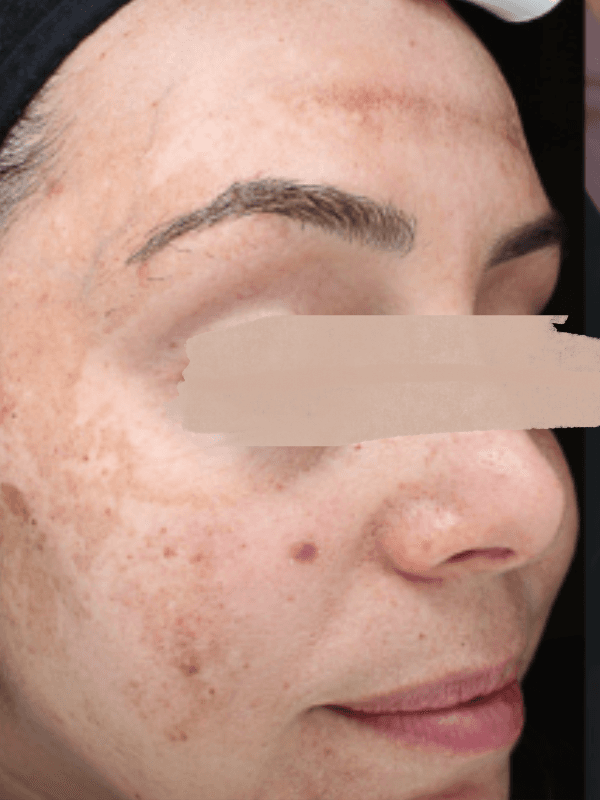 Before Melasma Treatment