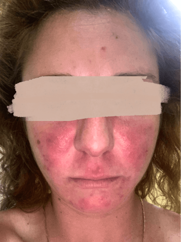 Before rosacea type 2 treatment showing severe facial redness and inflammation