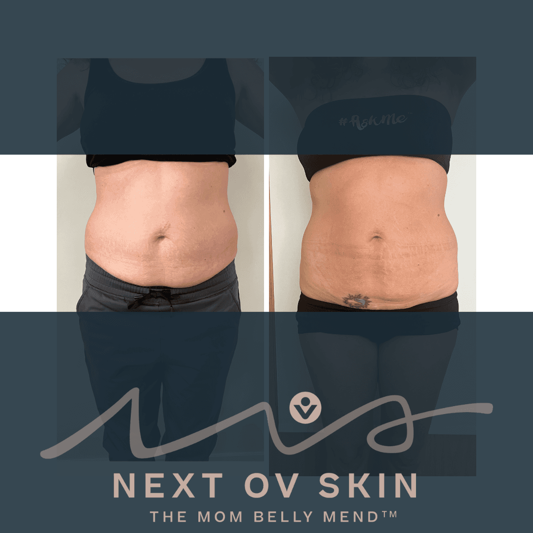 Body contouring results showing reduced waistline