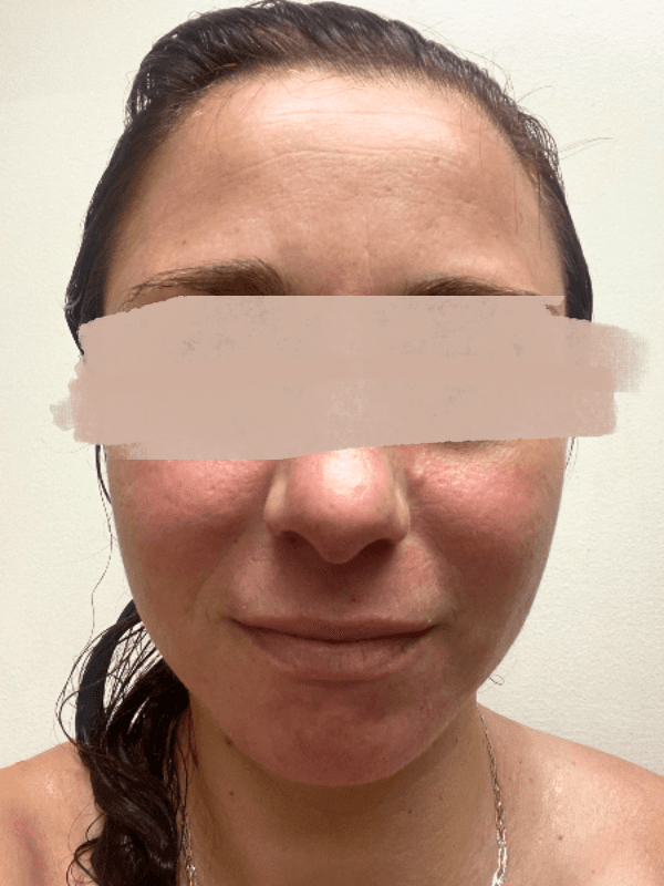After rosacea type 2 treatment showing dramatically reduced redness