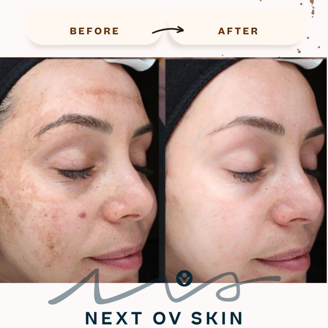 Sun damage correction before and after laser treatment