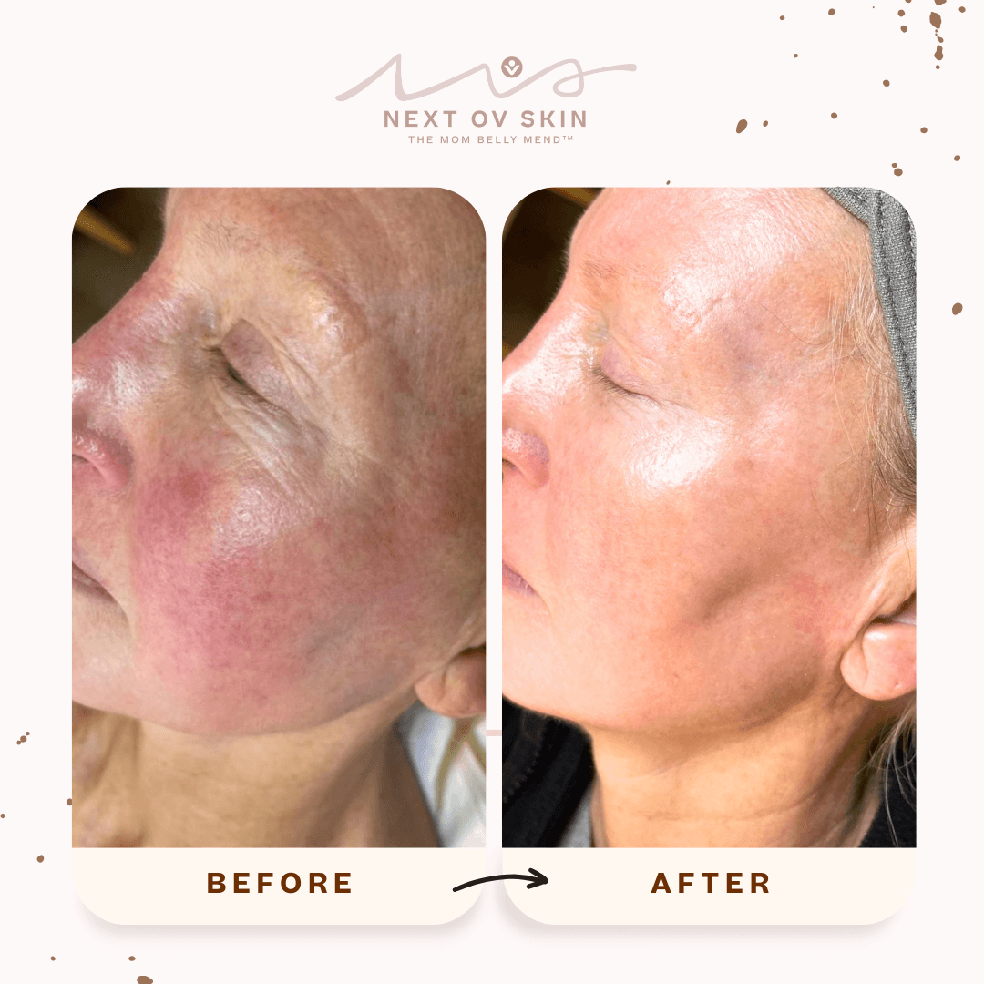 Facial redness reduction before and after IPL treatment