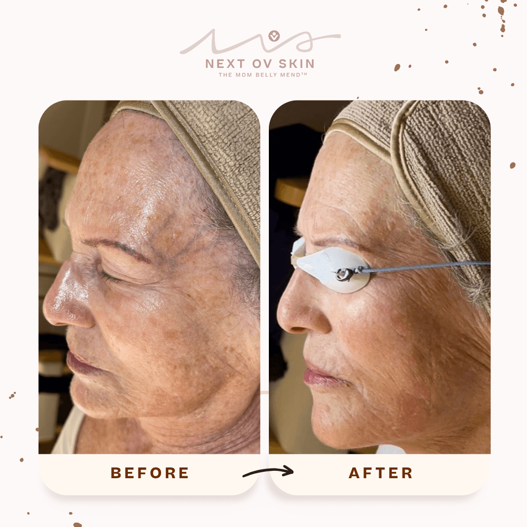 Melasma treatment before and after pico laser toning