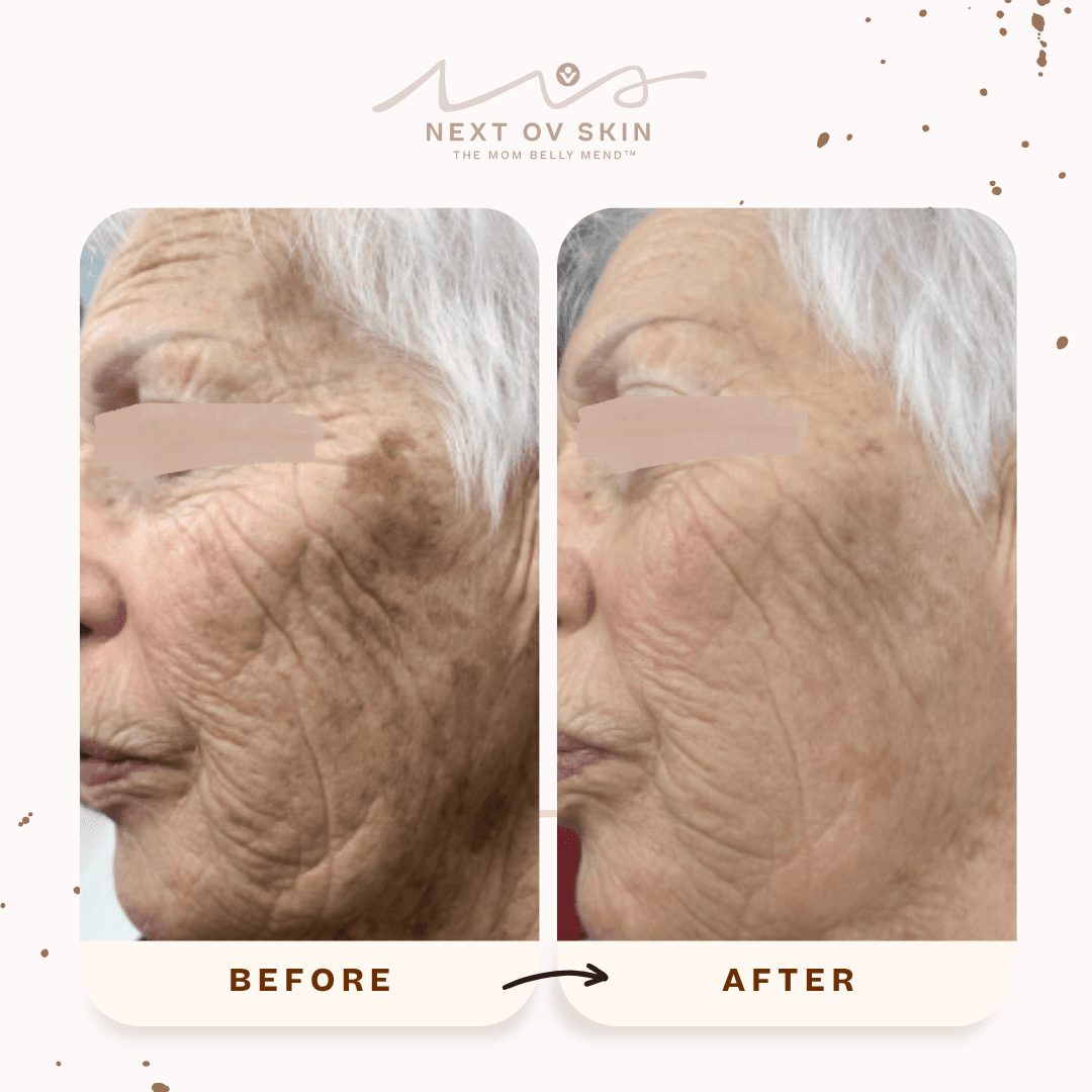 Hyperpigmentation treatment before and after showing faded dark spots