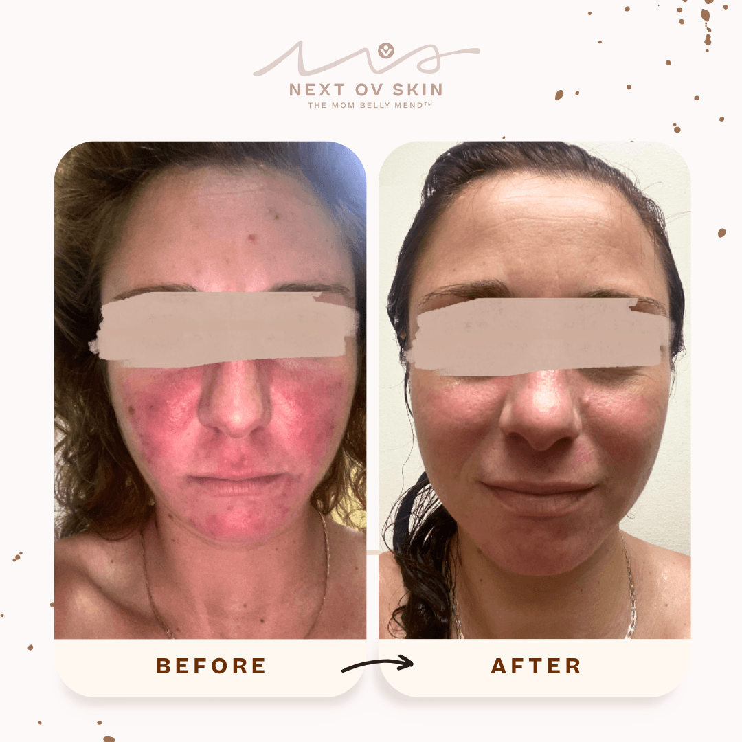 Rosacea laser treatment before and after showing reduced redness on cheeks