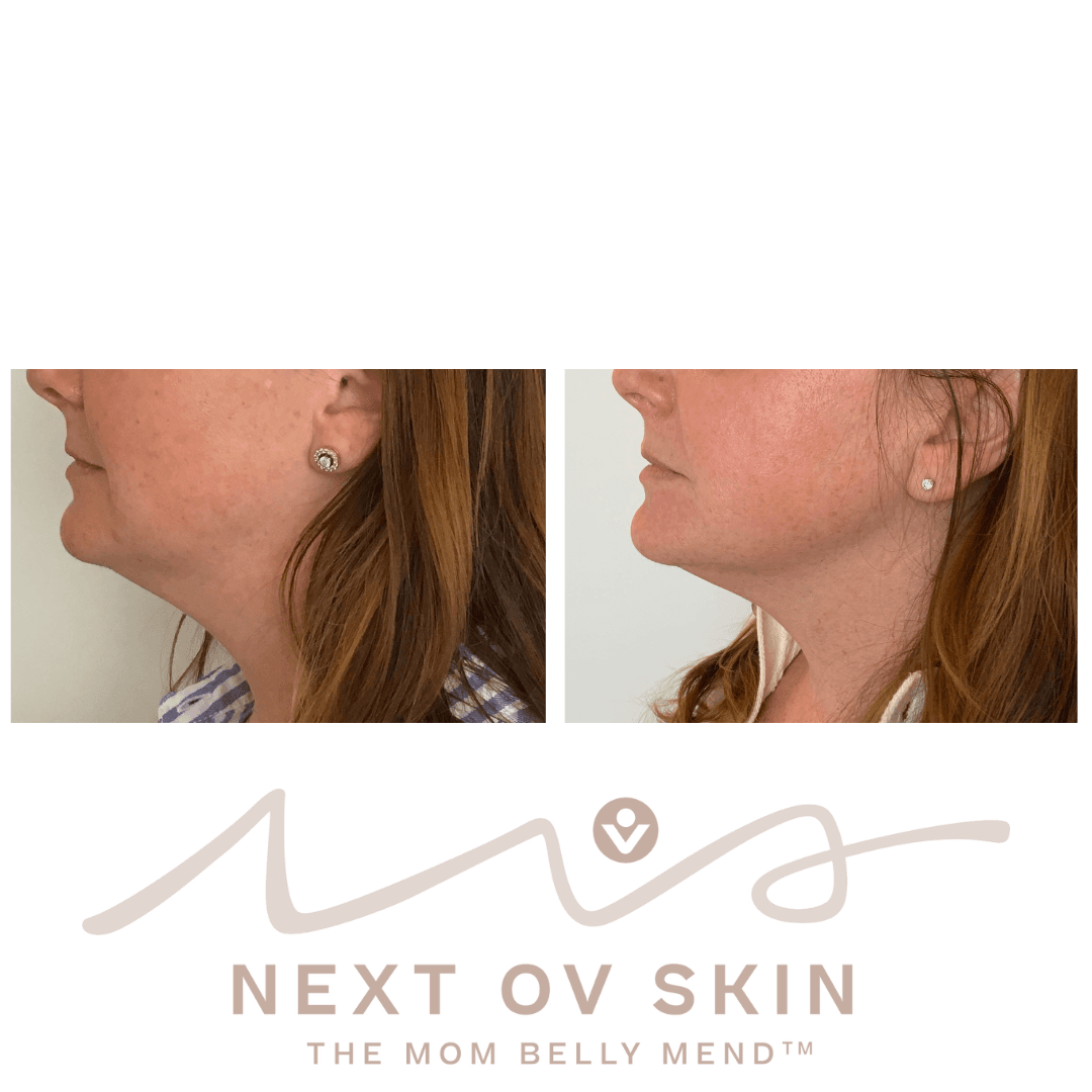 Double chin reduction before and after HIFU treatment