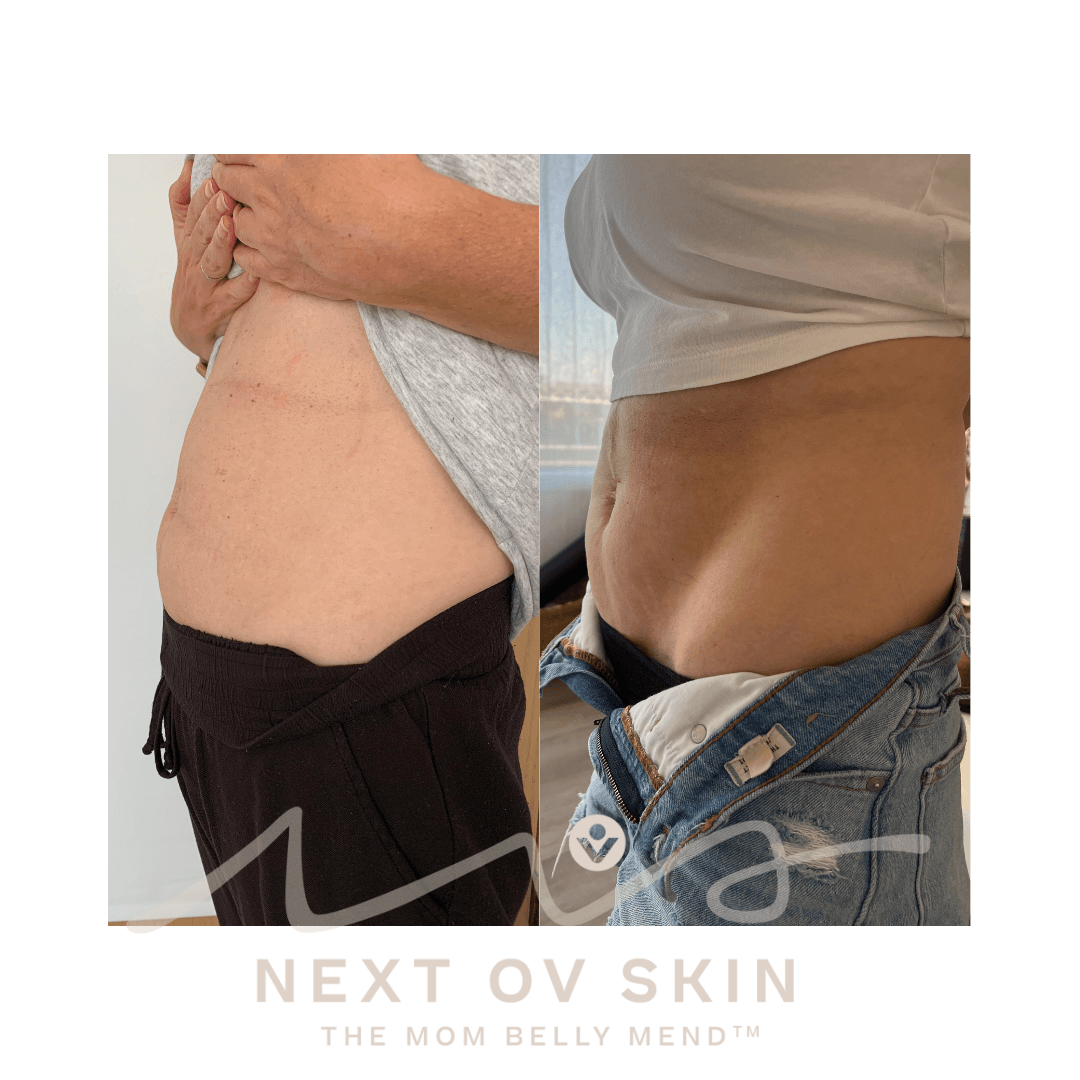 HIFU body sculpting results showing slimmer abdomen