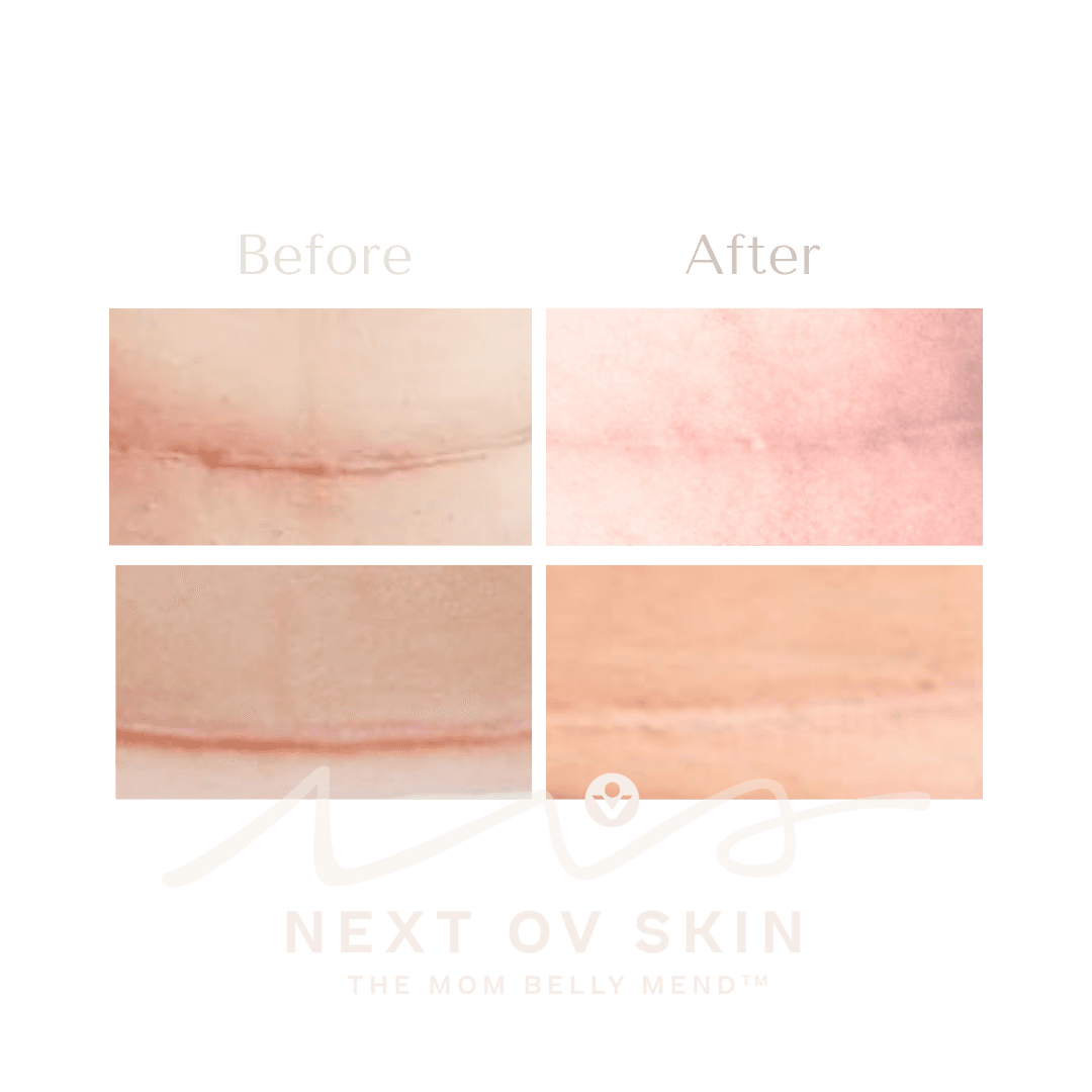 Cesarean scar recovery showing flattened and faded scar tissue
