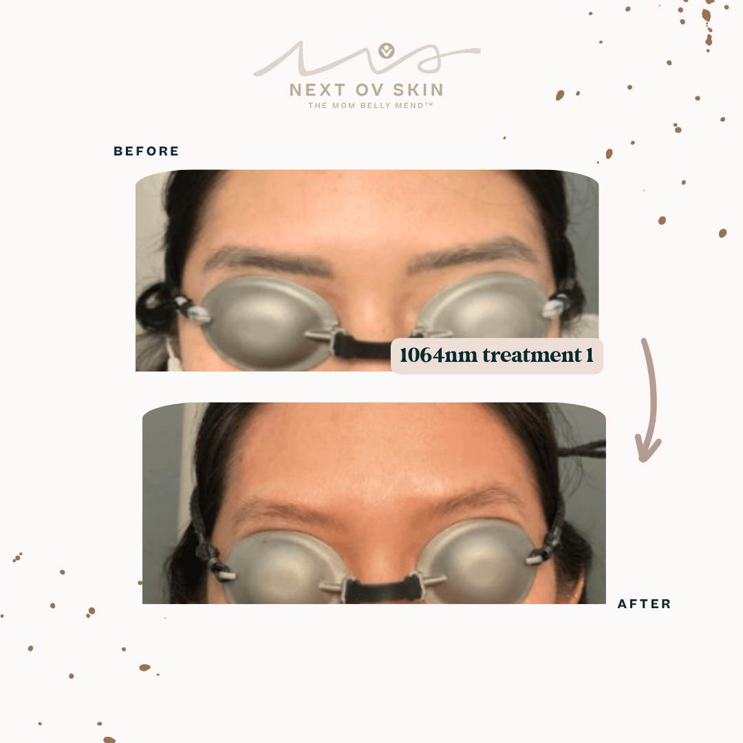 Eyebrow microblading before laser removal