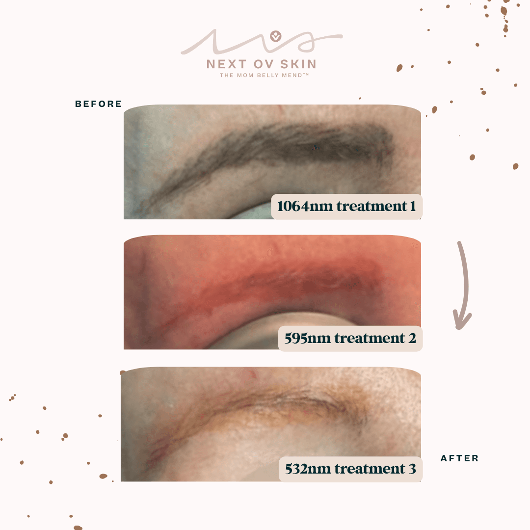 Eyebrow microblading after multi-wavelength laser treatment