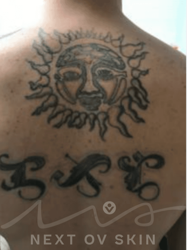 Large back tattoo with dark ink before removal