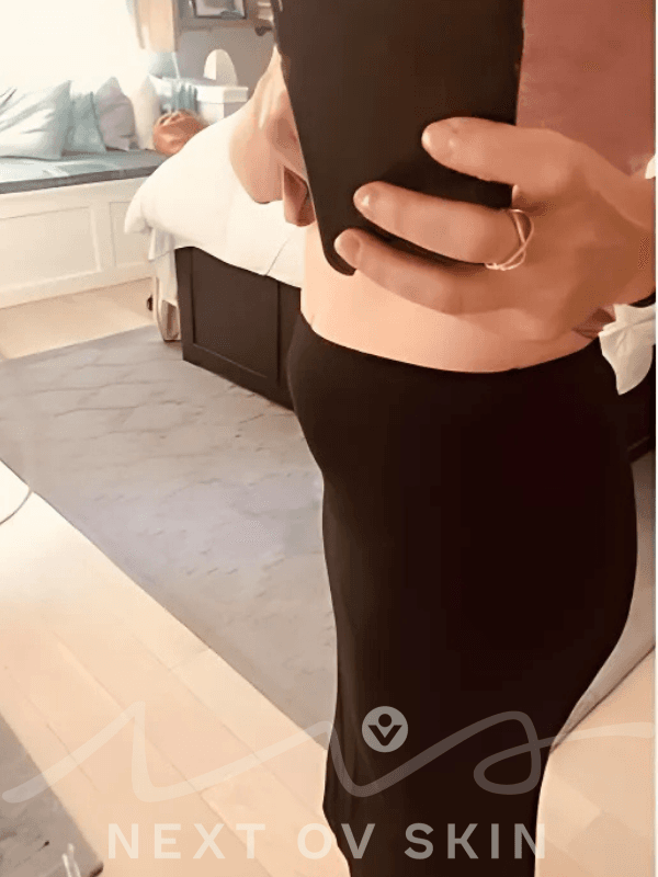 Before postpartum belly treatment - side view
