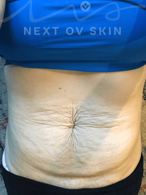 Before postpartum belly treatment - front view