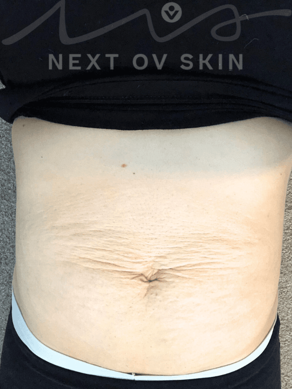After MomBellyMend treatment - front view