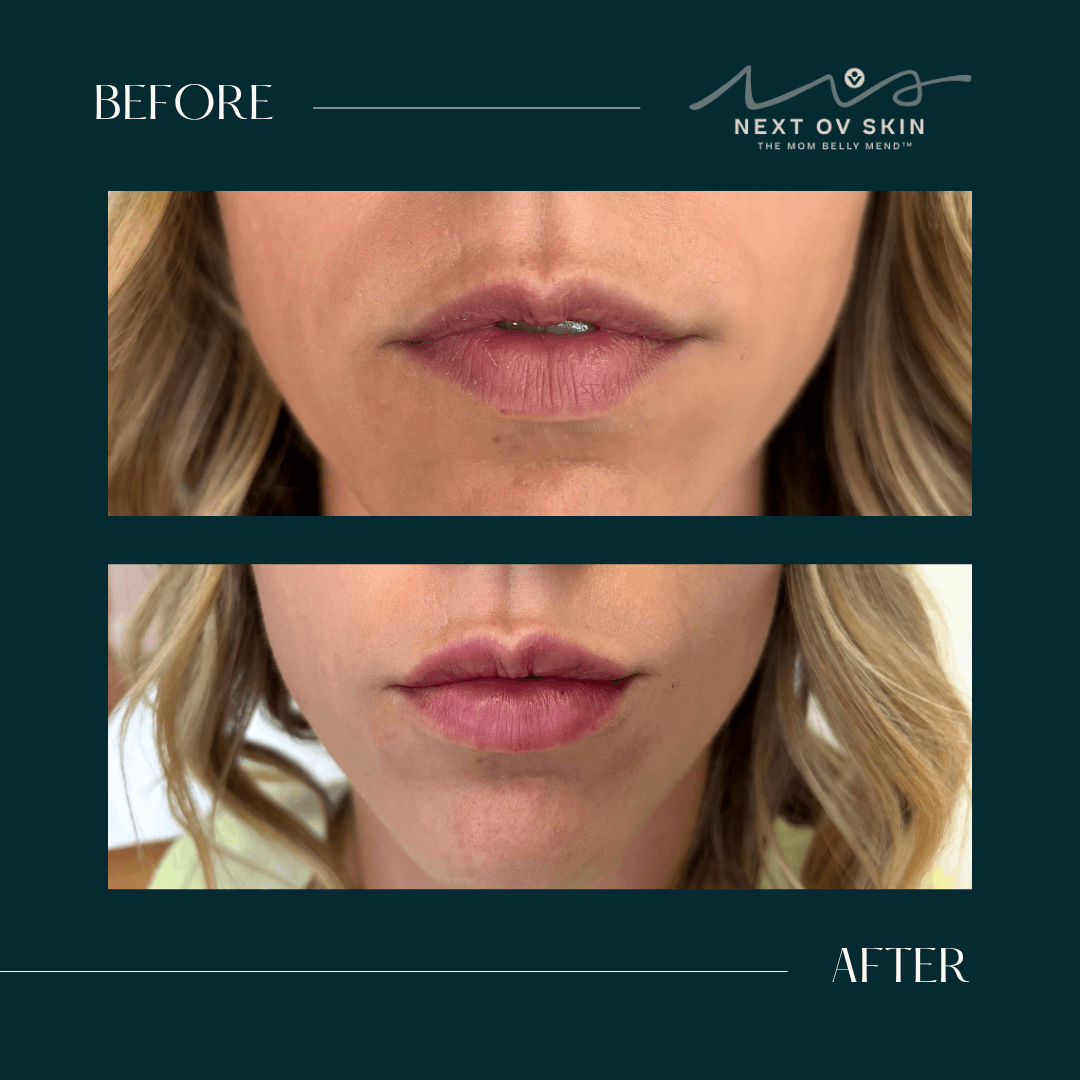 Before and after lip filler results showing natural volume enhancement by Nurse Jayme