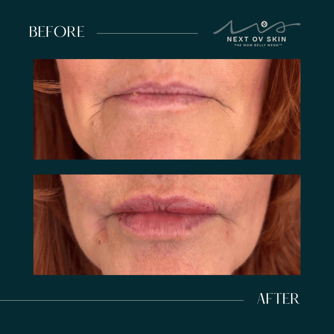 Before and after lip filler results showing subtle refinement by Nurse Jayme