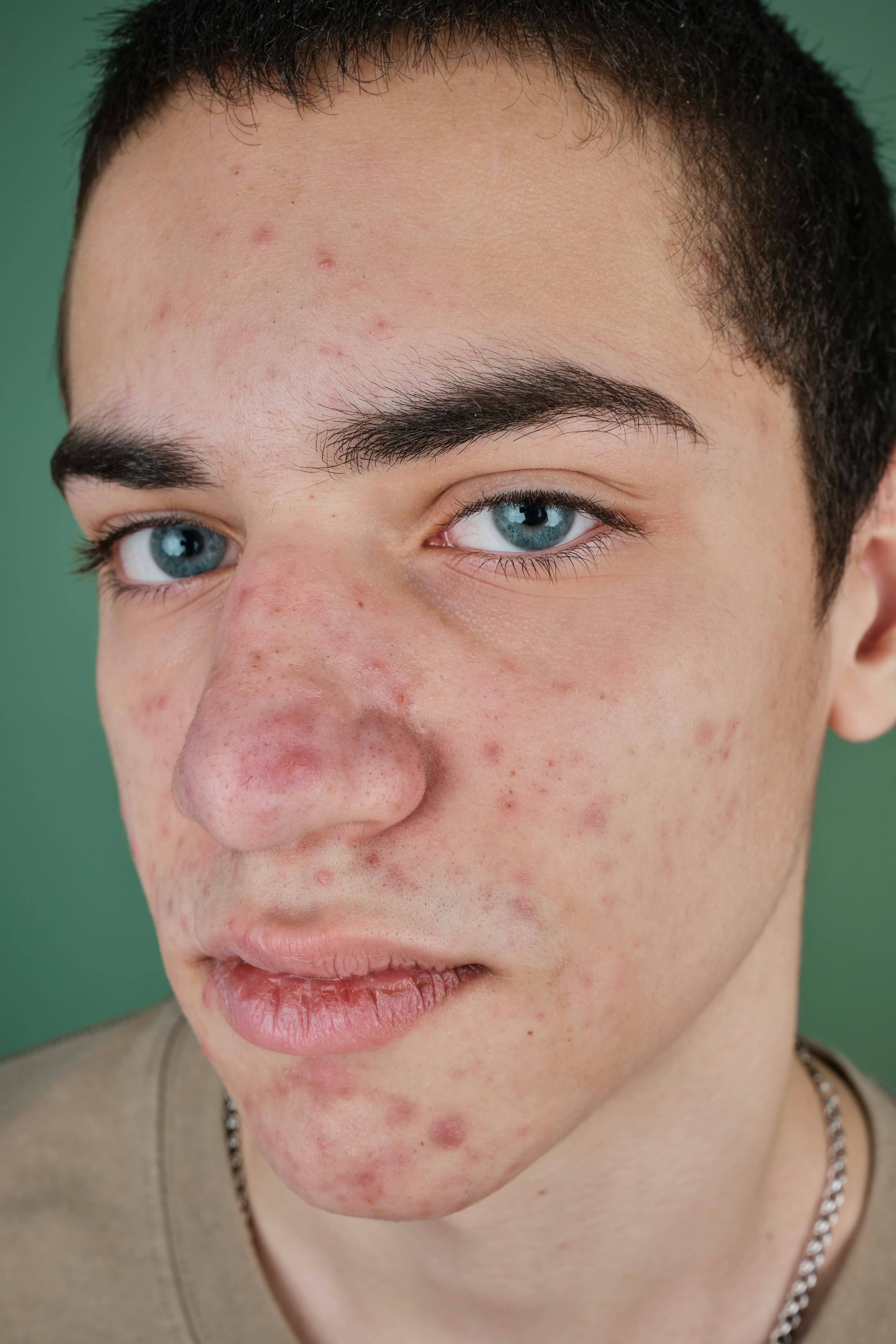 Teen facing acne concerns