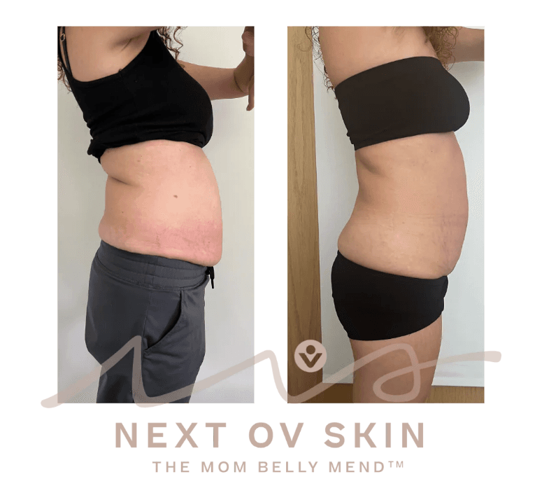 Before and after HIFU body sculpting results at Next OV Skin