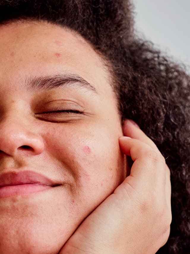 Laser Facials for Teens