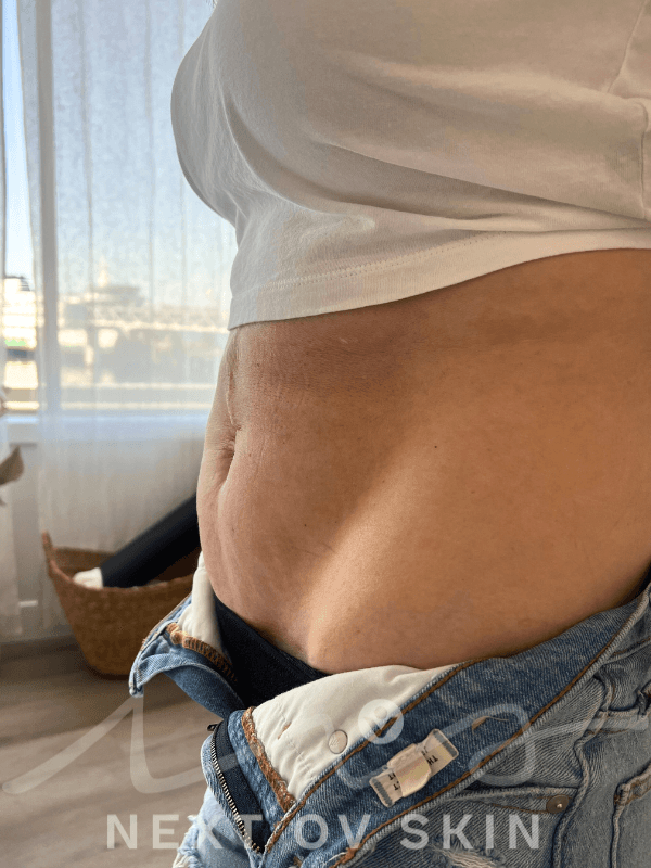 When to Begin C-Section Scar Massage: Timing & Techniques