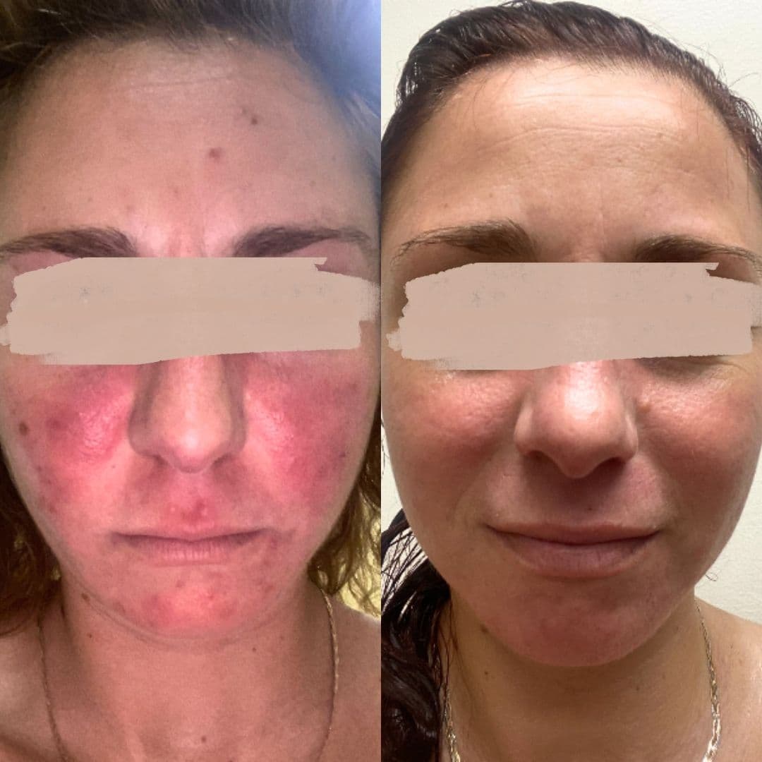 The Science Behind PICO Laser Technology: Why Picoseconds Matter