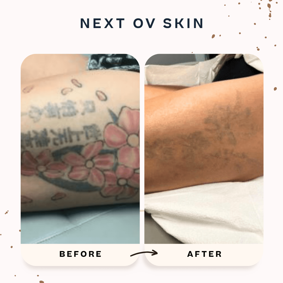 Tattoo removal results showing what full removal can look like