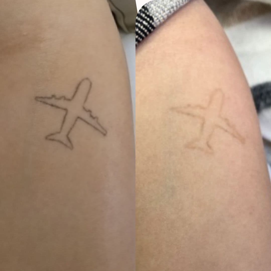 Tattoo Removal: The Science Behind Laser Technology